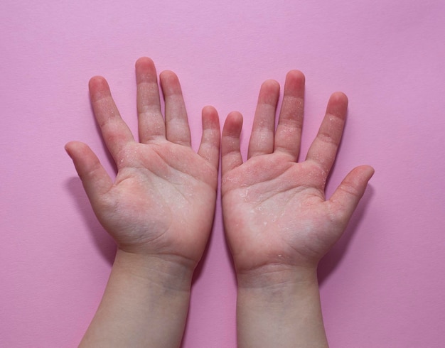 Dermatitis Kinderfinger-Hautinfektion schwere Infektion