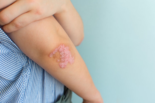 Foto dermatología del concepto. primer plano de psoriasis en los registros, sobre un fondo azul. enfermedades y cuidados de la piel