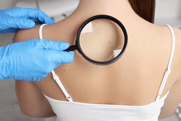 Dermatologista examinando marca de nascença do paciente 39 com lupa na clínica closeup