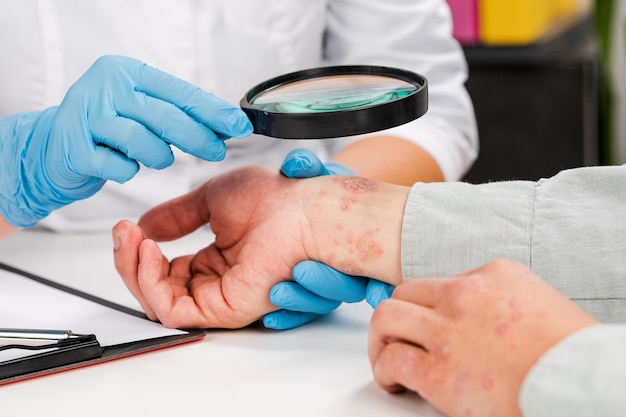Un dermatólogo con guantes examina la piel de un paciente enfermo Examen y diagnóstico de enfermedades de la piel alergias psoriasis eczema dermatitis