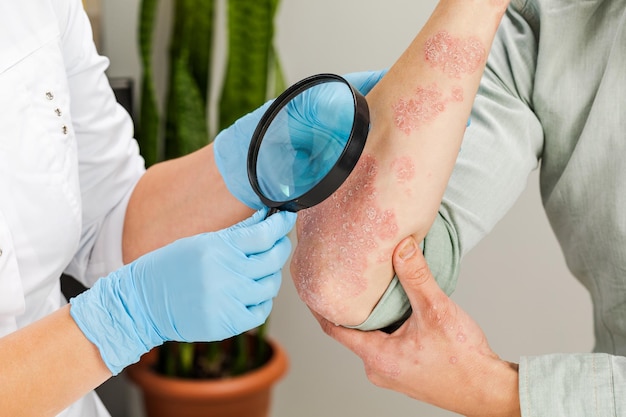 Foto un dermatólogo con guantes examina la piel de un paciente enfermo. examen y diagnóstico de enfermedades de la piel: alergias, psoriasis, eczema, dermatitis.