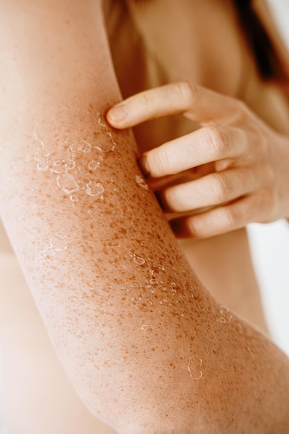 Descamación de la piel después de problemas dermatológicos de quemaduras solares en la mujer descamación de la piel de manos y hombros y concepto de cuidado de la piel piel sensible