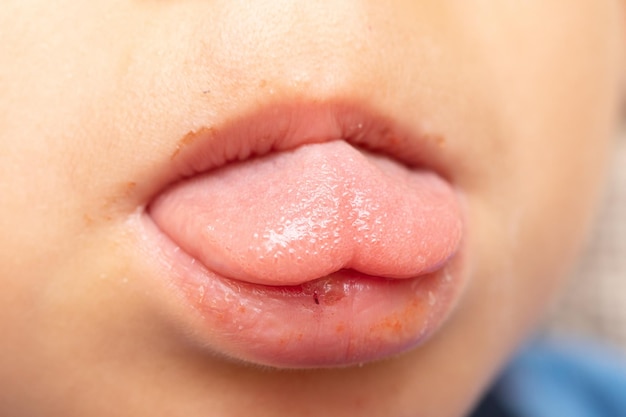 Details der Lippen eines Kindes mit einer Wundinfektion