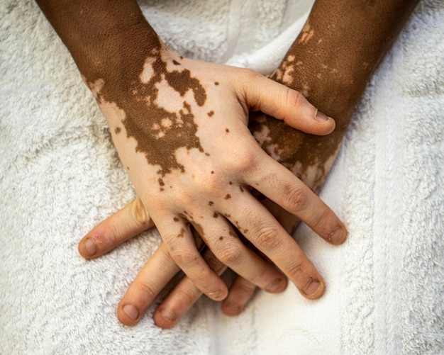 Details von Hauttönen an den Händen einer jungen Afrikanerin mit Hautvitiligoskin-Pflege und genetischer Melatoninveränderung