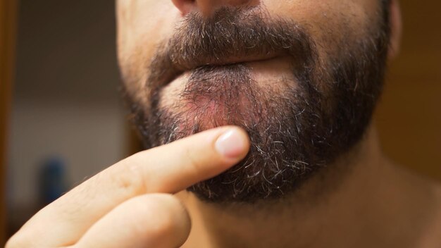 Detalhe do queixo do homem com dermatite seborreica na região da barba