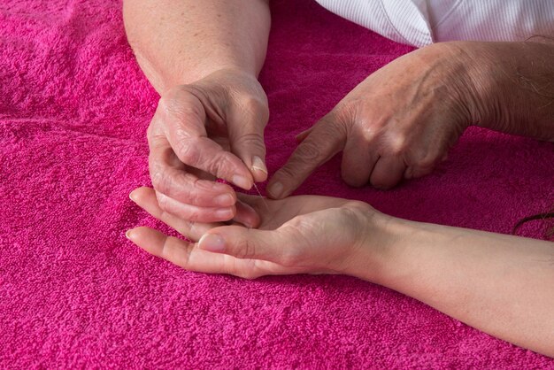 Detalle del acupunturista colocando una aguja en la mano del paciente