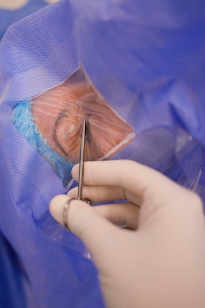 Detalle de un cirujano preparando el área alrededor del ojo para una cirugía