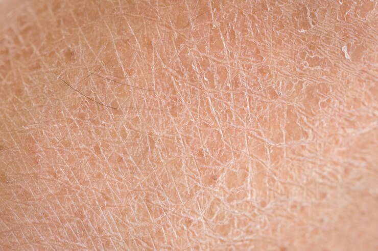 Detalle macro piel seca (ictiosis)
