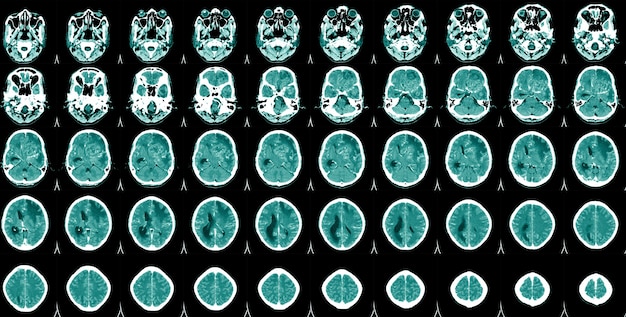 Día Mundial del Accidente Cerebrovascular Tomografía computarizada del cerebro Un hombre que sufre de dolor de cabeza pulsátil