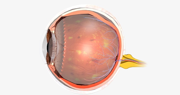 Diabetische Retinopathie ist eine Komplikation von Diabetes, die die Augen betrifft