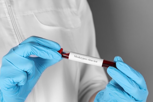 Diagnóstico do vírus Monkeypox Trabalhador de laboratório segurando tubo de ensaio com amostra de sangue em plano de fundo cinza closeup