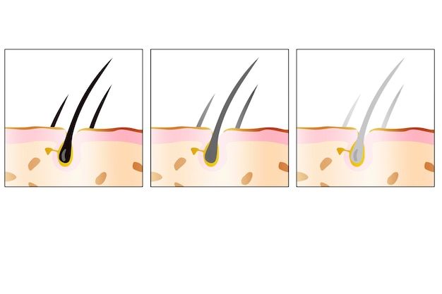 Diagrama de cabello negro, gris y blanco.