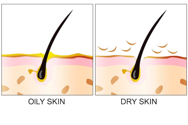 Diagrama de pele oleosa e seca isolado