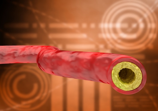 Diagramm mit cholesterintest beim patienten, ergebnis mit vene und arterie mit ansammlung von fetten