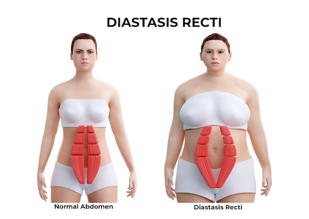 La diástasis abdominal es la separación parcial o completa de los músculos rectos abdominales, común durante y después del embarazo. Ilustración 3D