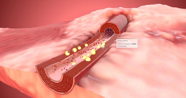 Die Arterie erweitert sich aufgrund des Anstiegs der ARBs im Blut
