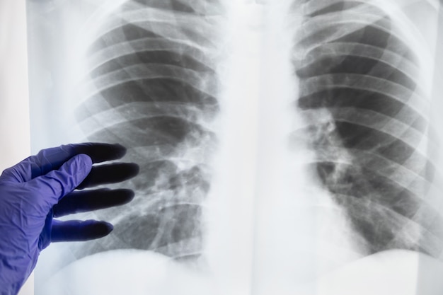 Foto die hand des doktors hält eine röntgenaufnahme der menschlichen lunge.