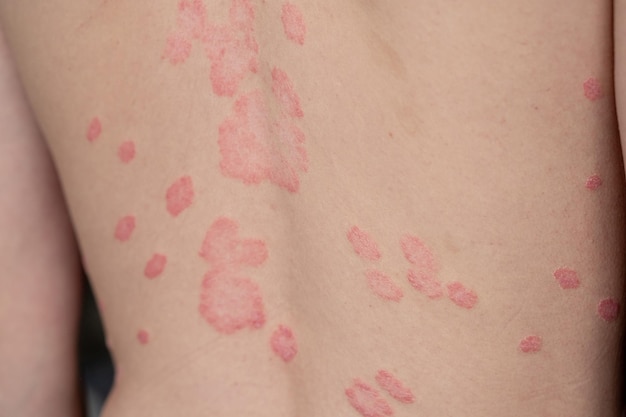 Die Hautflecken der Psoriasis vulgaris sind typischerweise rot, juckend und schuppig