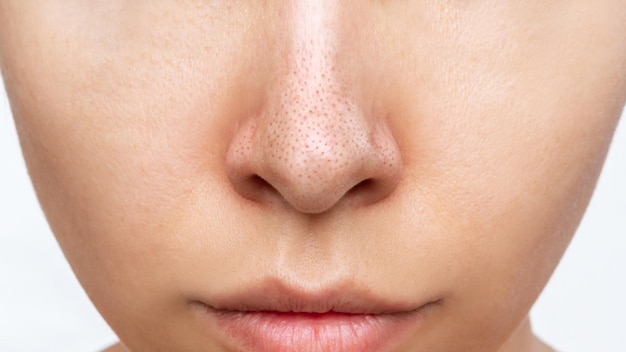 Die Nase der Frau mit schwarzen Köpfen oder schwarzen Punkten. Akneproblem, Komedonen. Vergrößerte Poren im Gesicht