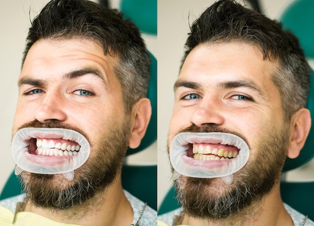 Foto dientes blancos antes y después del concepto detalle de primer plano de los dientes del hombre antes y después del resultado de blanqueamiento o