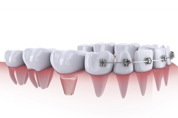 Dientes e implantes