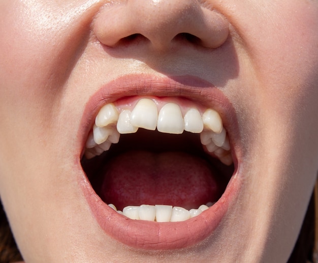 Dientes femeninos curvados, antes de instalar los frenillos. Primer plano de los dientes antes del tratamiento por parte de un ortodoncista