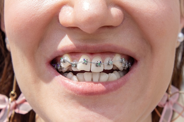 Dientes femeninos curvados, después de instalar brackets. Primer plano de los dientes después del tratamiento en el ortodoncista. Sistema de calafateo en la boca sonriente de una niña, fotografía macro de dientes. Frenillos en los dientes de la niña.