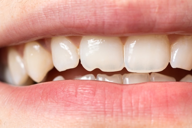 Dientes humanos astillados con primer plano de defecto.