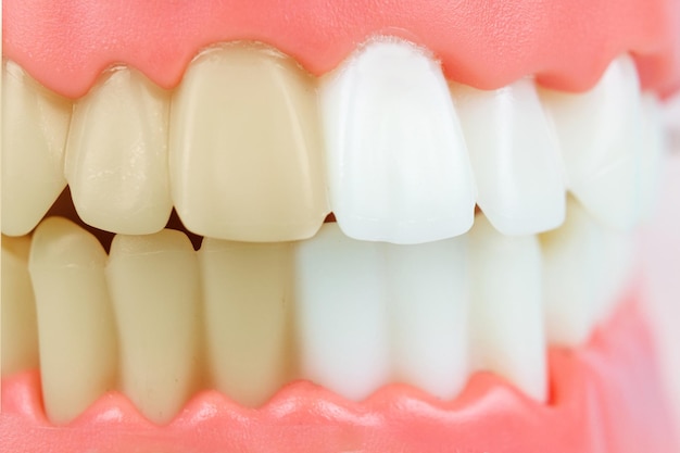 Dientes limpios y sucios antes y después de blanquear las dentaduras postizas Modelo de dientes dentales de cerca sobre fondo azul
