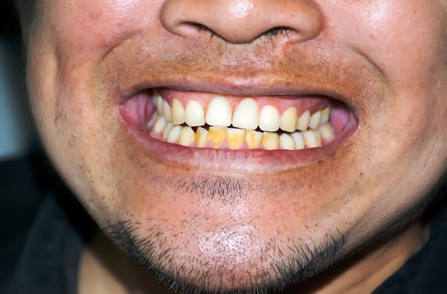 dientes malos dientes y sonrisa antes del tratamiento