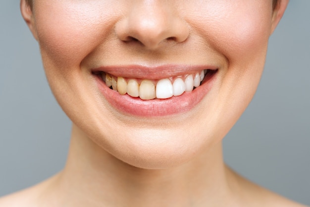 Los dientes de la mujer antes y después del blanqueamiento sobre fondo blanco simboliza la imagen del paciente de la clínica dental