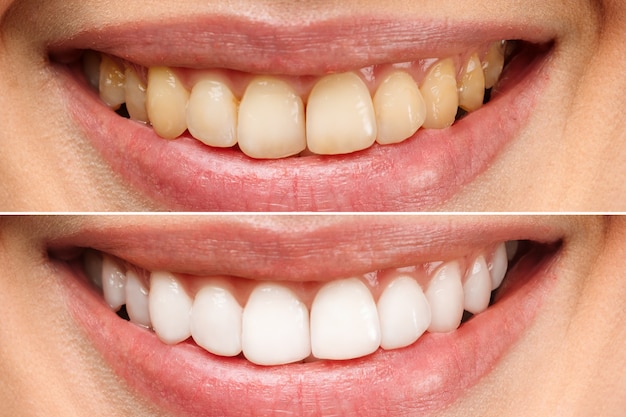 Los dientes de la mujer antes y después del blanqueamiento sobre fondo blanco simboliza la imagen del paciente de la clínica dental