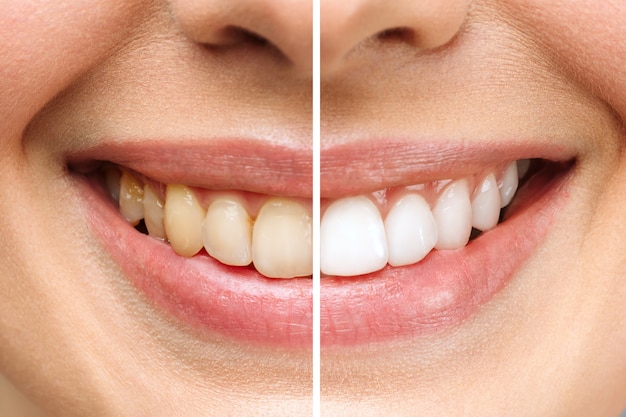 Los dientes de la mujer antes y después del blanqueamiento sobre fondo blanco simboliza la imagen del paciente de la clínica dental