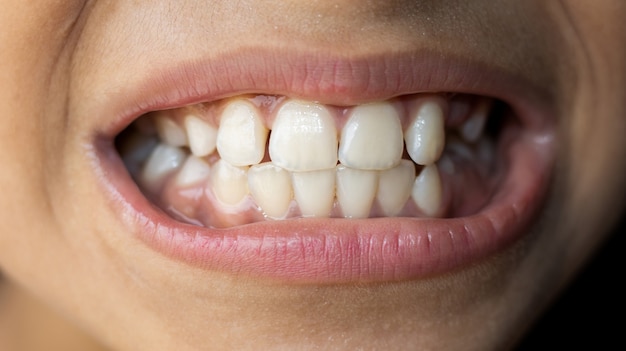 Los dientes de un niño pequeño con pocas partículas de comida vista cercana