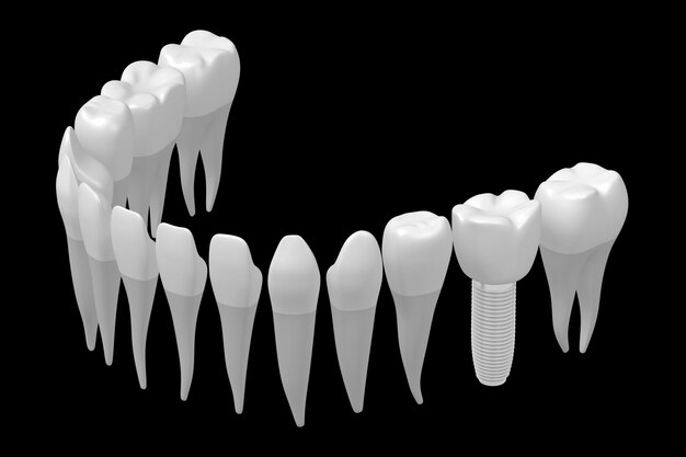 Dientes de salud y un implante aislado sobre fondo blanco ilustración 3D