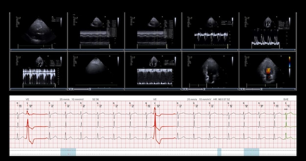 Dies ist ein Screenshot der Ansicht eines transthorakalen Ultraschallkardiogramm-Echoherzbildschirms, der das Herz auf einem digitalen Tablet untersucht