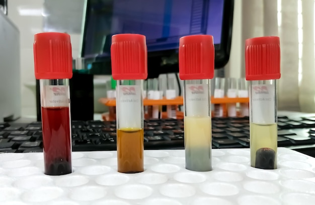 Foto diferentes tipos de soro contêm amostras de sangue que podem interferir no valor do teste bioquímico