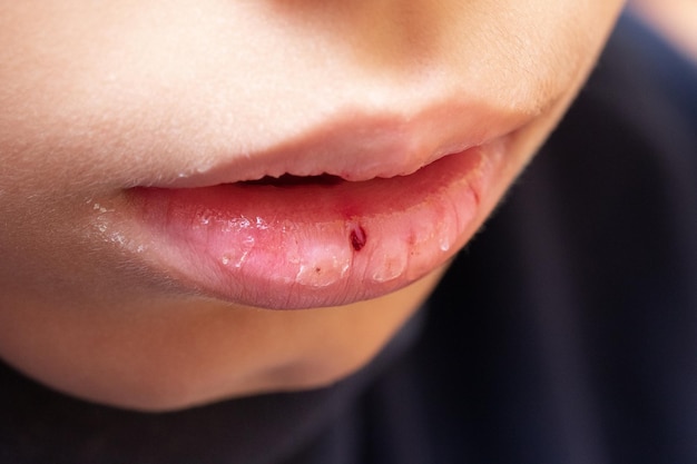Distúrbios e doenças dos lábios em jovens como prevenir o ressecamento labial