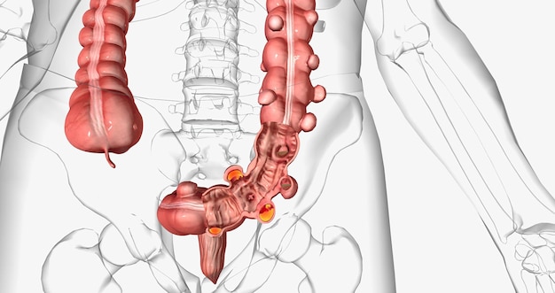 La diverticulosis ocurre cuando se desarrollan pequeñas bolsas abultadas en el tracto digestivo.