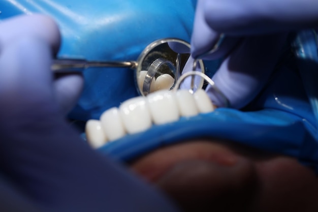 Doctor dentista instalando carillas en los dientes del paciente usando herramientas metálicas de cerca