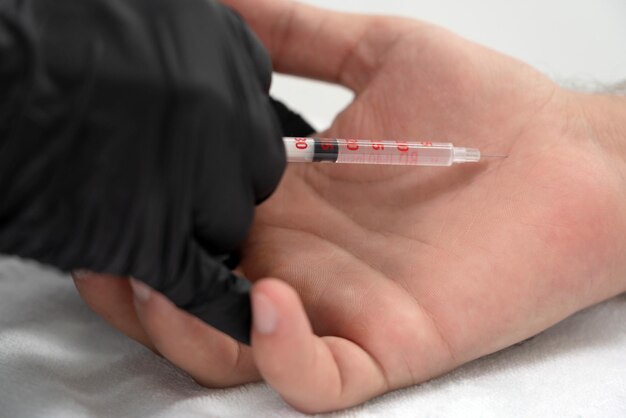 Doctor hace una inyección de toxina botulínica en la mano de una palma masculina contra la sudoración excesiva