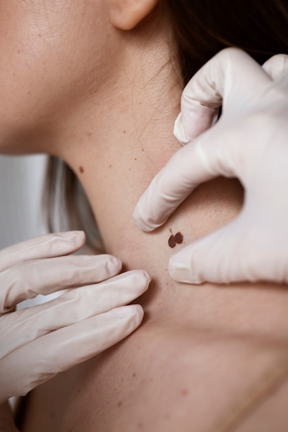 Foto doctora diagnosticando un melanoma en el cuerpo de una paciente