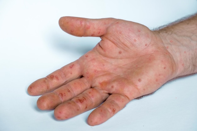 Doença de Monkeypox Paciente com erupção cutânea de Monkey Pox na mão Feche erupção cutânea mãos humanas Espaço de cópia de banner