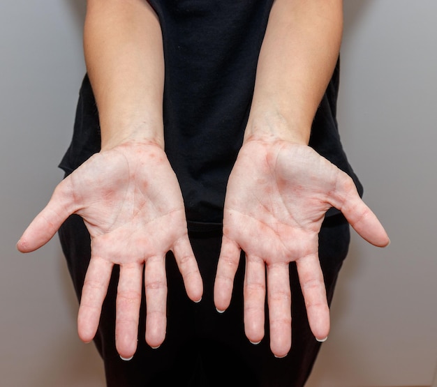 Foto doença de pele de eczema disidrótico nas palmas das mãos