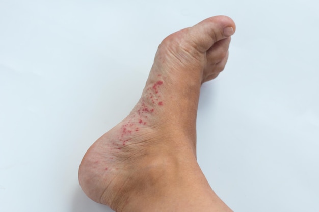 Doença infecciosa das pernas Fungo nos pés e erupção cutânea alérgica
