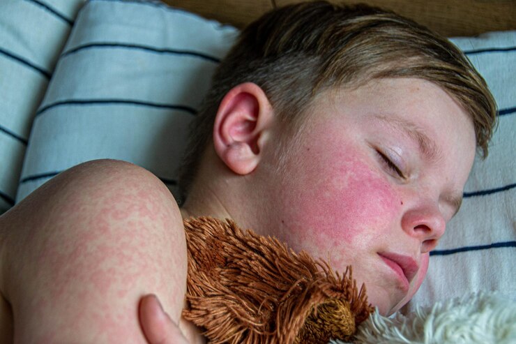 Foto doenças virais sarampo erupção cutânea no corpo da criança alergia