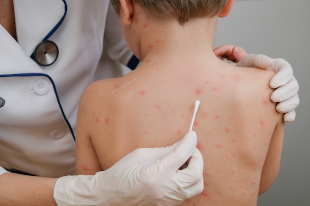 Doktor, der Creme auf Babys Haut mit den Blasen und Hautausschlag verursacht durch Windpocken aufträgt