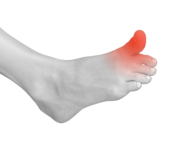 Dolor en el dedo gordo del pie contusión del pie por tensión o lesión dolor en las articulaciones tensas con neuropatía o artritis