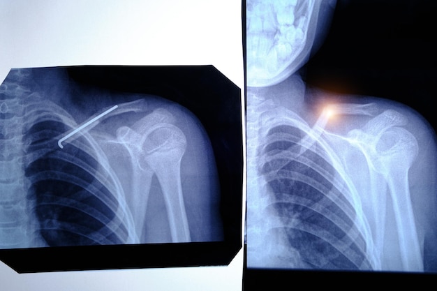 Dos imágenes de rayos X hombre con clavícula fracturada y un espacio insertado después de la cirugía