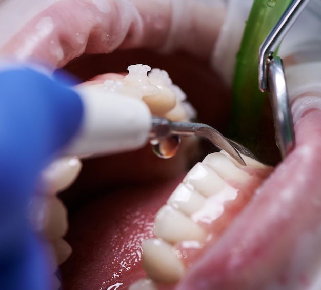 Doutor que faz a limpeza profissional dos dentes na clínica odontológica